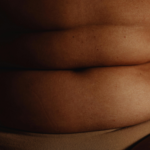 PCDC fat dissolving injections provide non-surgical fat reduction for precise body contouring.